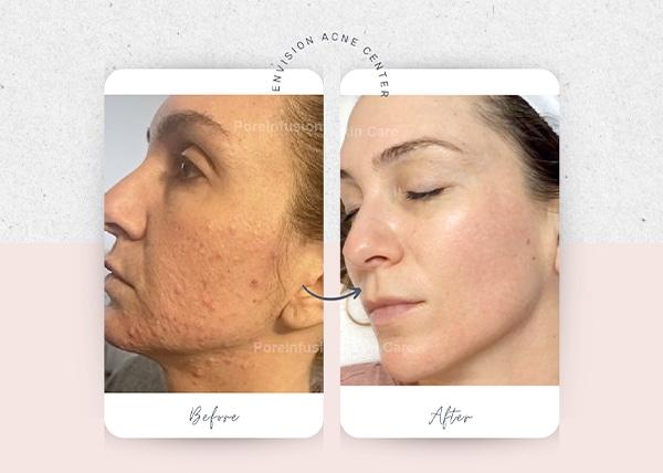 transformation-pore-infusion