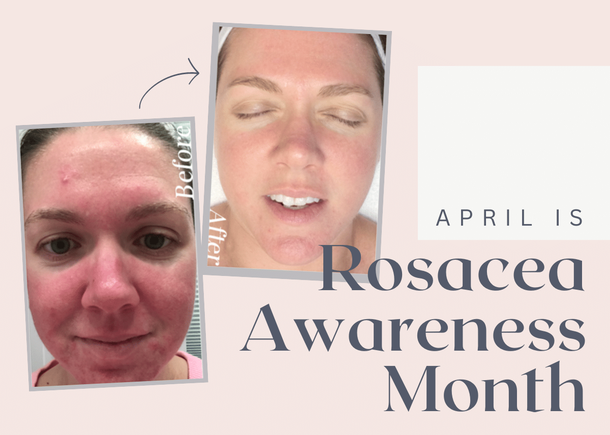 Pore Infusion Rosacea