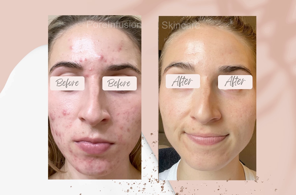Pore Infusion blog cover 2
